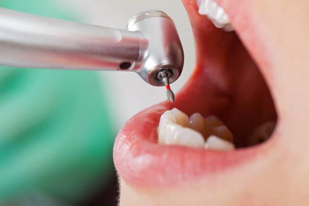 Best Emergency Wisdom Teeth Removal in Waggaman, LA